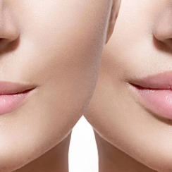 How to increase lip volume without surgery
