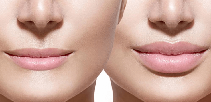 How to increase lip volume without surgery
