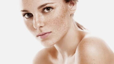 Ways to remove age spots on the face