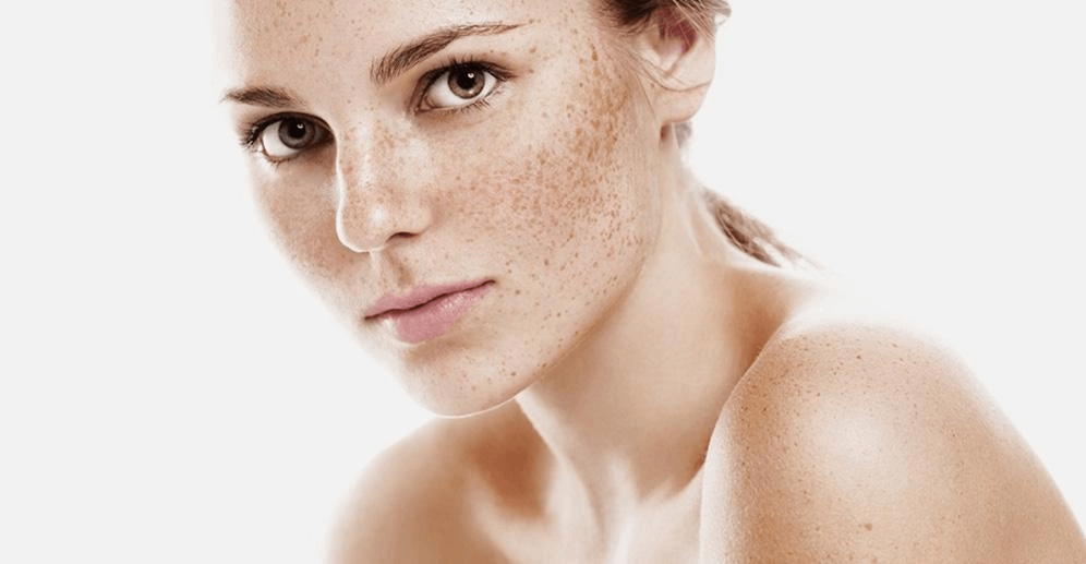 Ways to remove age spots on the face